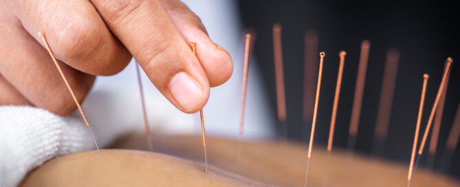 Akupunktúra